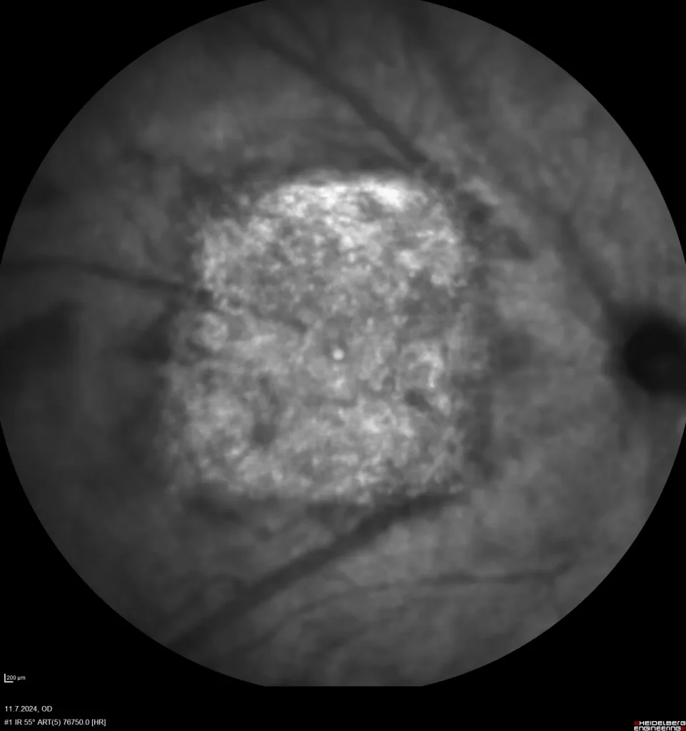 ARVO 2025 presentation: Triamcinolone delays retinal atrophy in a mouse laser-induced geographic atrophy model