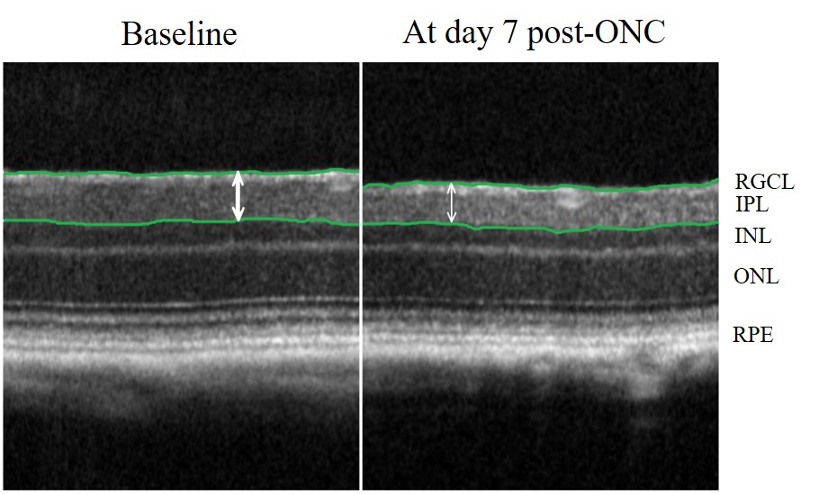 Fig. 1b. Retinal thickness as assessed from in vivo imaging (SD-OCT).