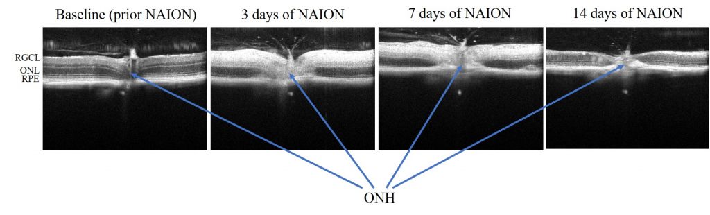 Fig. 2. SD-OCT of optic nerve head (ONH) and surrounding retinal area at 3 days, 7 days and 14 days after NAION induction in the same mouse eye.