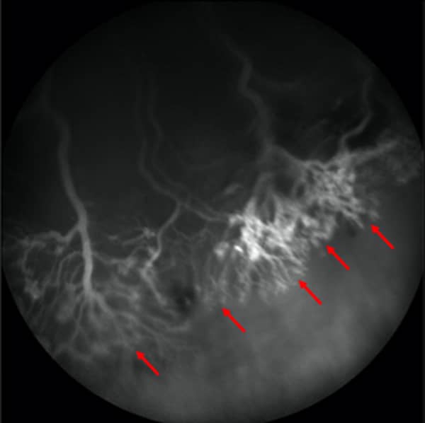Fluorescein angiography at post-natal day 20 (P20) from the rat Oxygen-Induced Retinopathy (OIR) model.